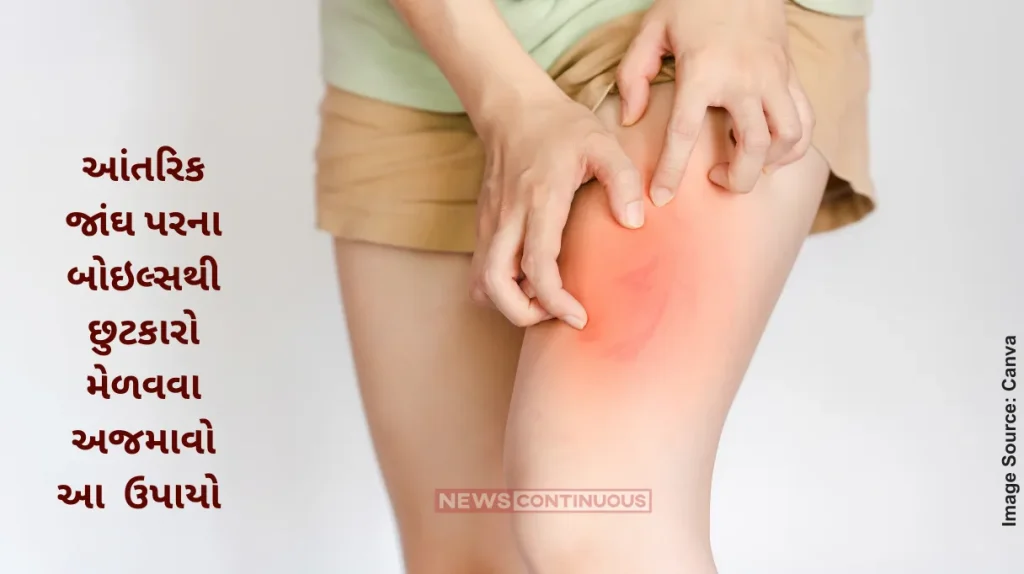 Home Remedies Natural Solutions To Get Rid Of Boils