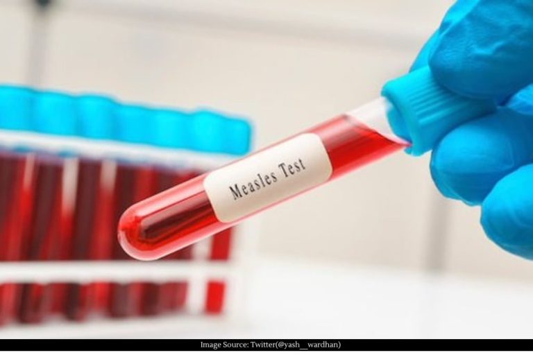 4 thousand 355 suspected patients of measles