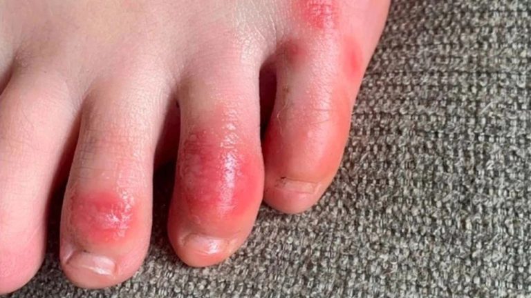 Swollen Finger Remedies in winter