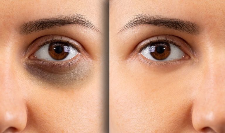 How To Use Besan For Dark Circle Reduction Home Remedies How To Use Besan For Dark Circle Reduction Home Remedies