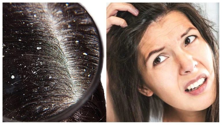 Hair Care Tips-Methods to get ride of dandruffs on hair