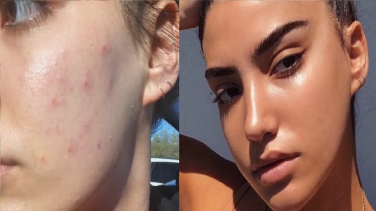 Flawless Skin-Do these changes in your lifestyle and diet to get Flawless Skin