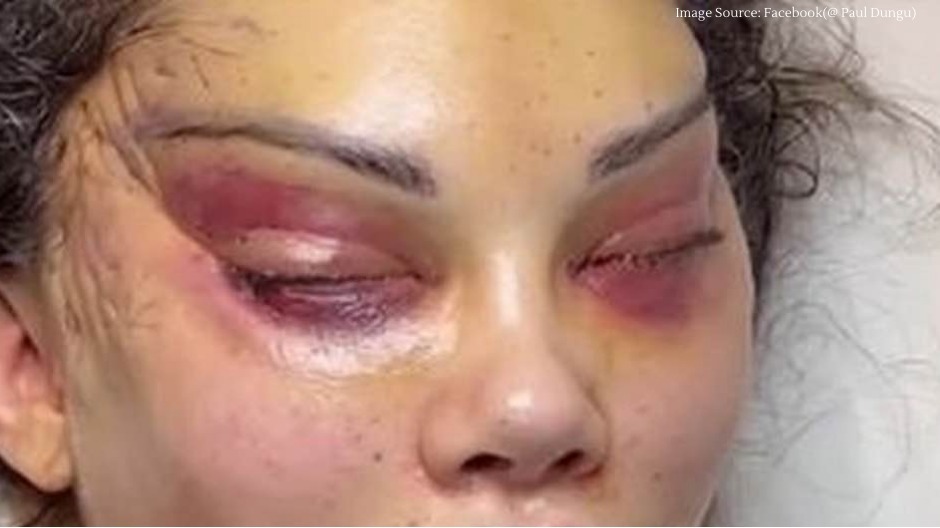 Influencer left with deformed face after undergoing invasive cat eye surgery