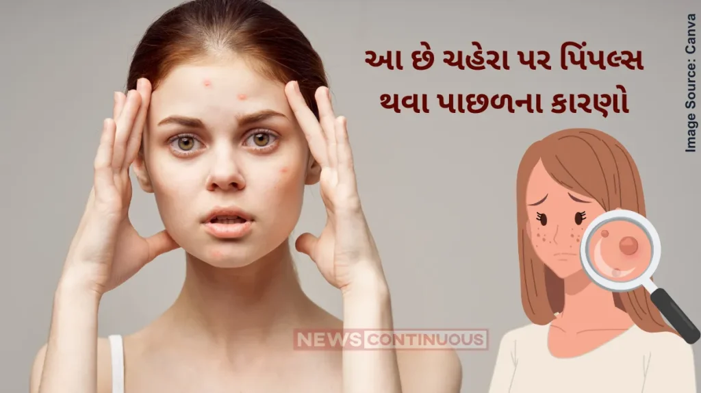 Causes Of Pimple What causes acne, and how do I treat it