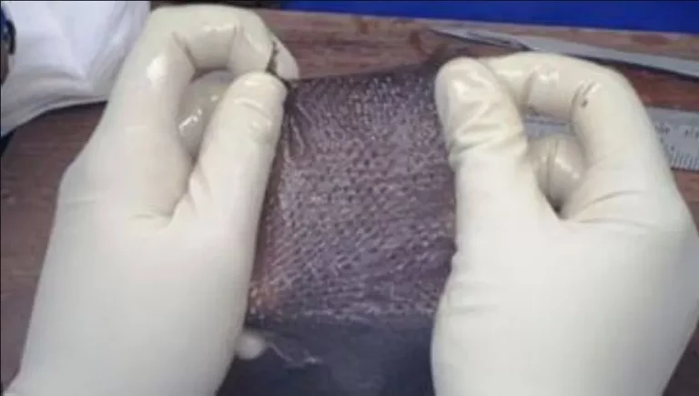 Organ Donation Maha Donation: Rajkot Civil received one more skin donation