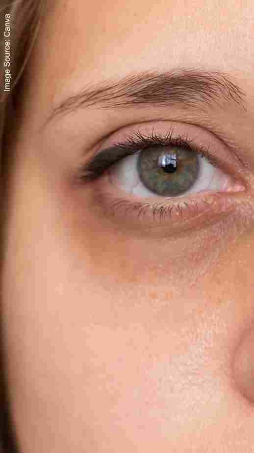 These 5 signs are seen in the body due to increased cholesterol levels  Eye These 5 signs are seen in the body due to increased cholesterol levels Eye