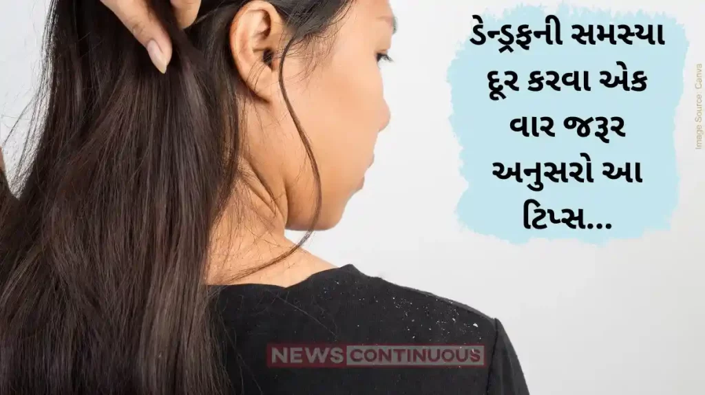 Dandruff Removal How To Treat Dry And Flaky Scalp Naturally At Home