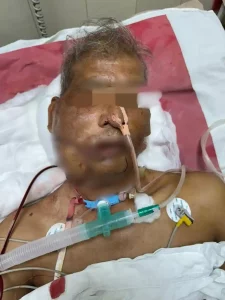 Free mouth cancer surgery done at this new civil hospital in Surat, 6 hours of complex surgery was done to open the completely closed mouth.