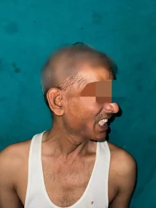 Free mouth cancer surgery done at this new civil hospital in Surat, 6 hours of complex surgery was done to open the completely closed mouth.