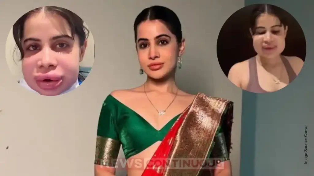 Urfi Javed Face Swells After Lip Fillers Removal Struggles to Speak