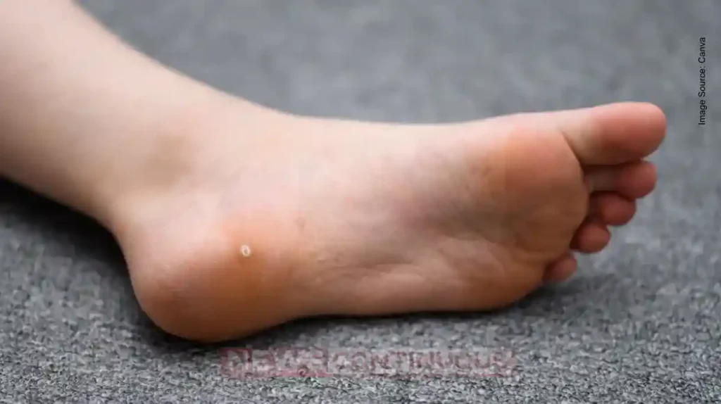 Don't Ignore Warts on Your Body Know Why They Appear and How to Treat Them