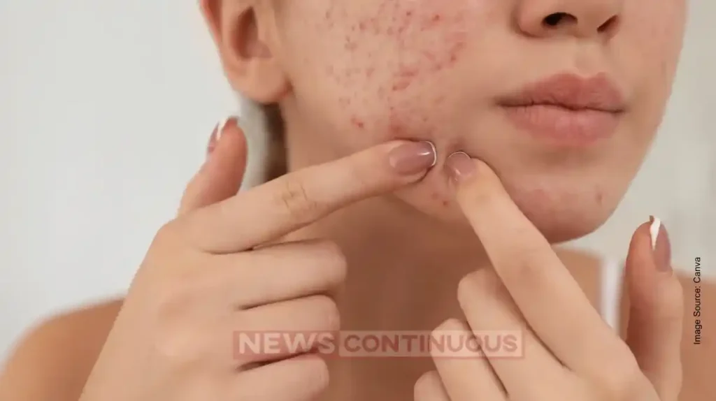 Pimple Popping Side Effects: Stop This Habit or Face Skin Damage