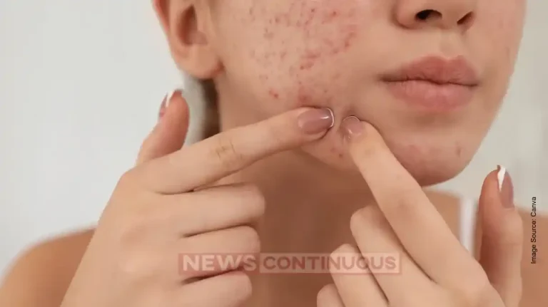 Pimple Popping Side Effects: Stop This Habit or Face Skin Damage