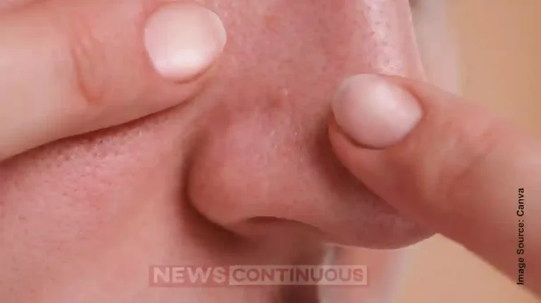 Blackheads vs Whiteheads: Know the Difference and How to Get Rid of Them Naturally