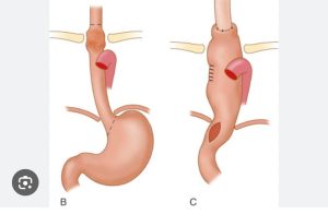 Civil Hospital Ahmedabad Performs Complex Gastric Pull-Up Surgery on 2.5-Year-Old