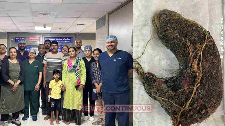 Civil Hospital Ahmedabad સિવિલ હોસ્પિટલમાં દુર્લભ સર્જરી દરમિયાન 7 વર્ષના બાળકના