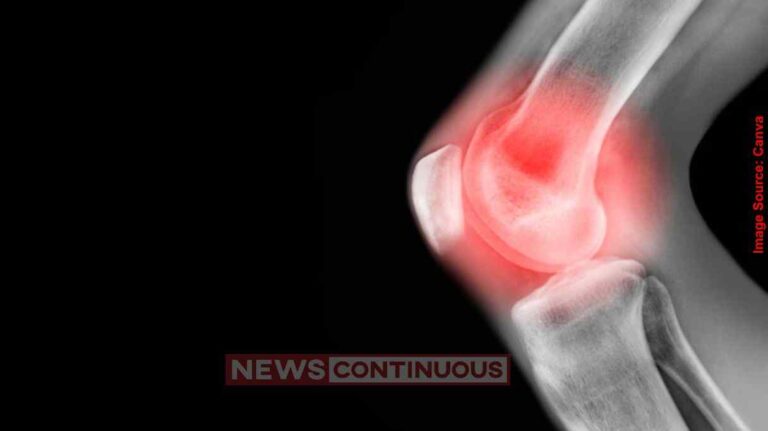 Arthritis Treatment હવે ઘૂંટણની સર્જરીની