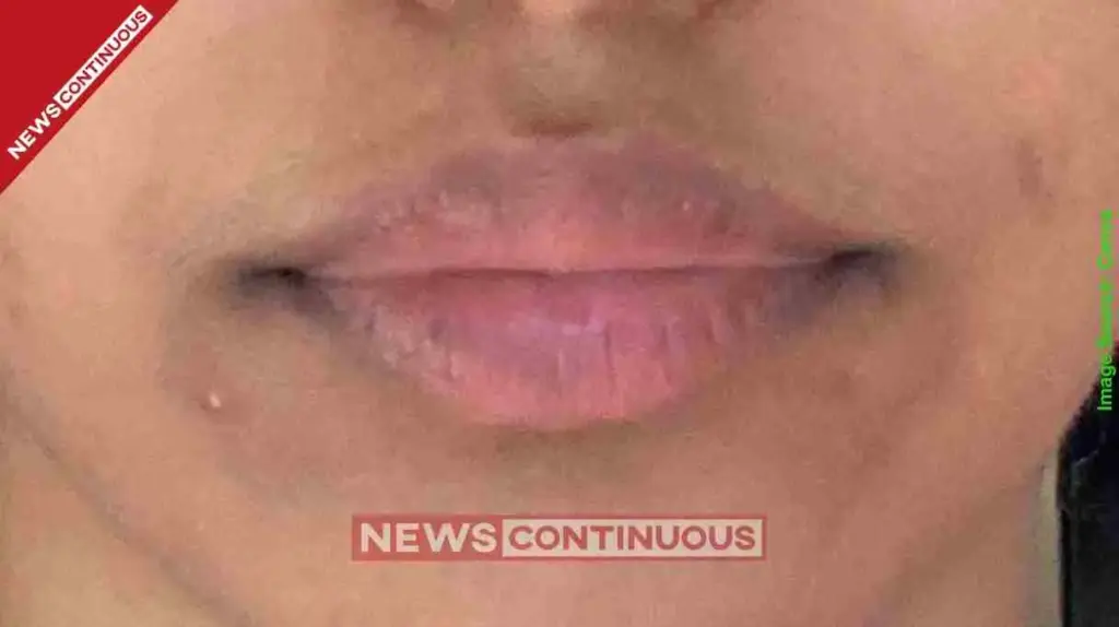 Dark circles around mouth Try this natural DIY cream shared by content creator to clear skin pigmentation fast.