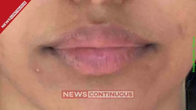 Dark circles around mouth Try this natural DIY cream shared by content creator to clear skin pigmentation fast.