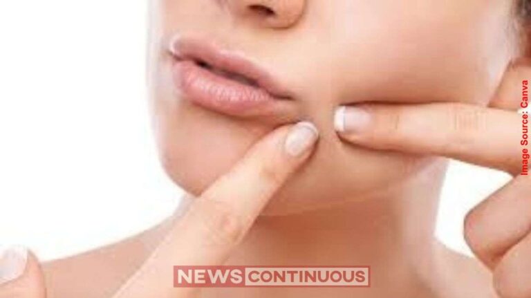 Pimple Popping Side Effects ખીલ ફોડવાથી ચહેરો થઈ શકે છે ખરાબ