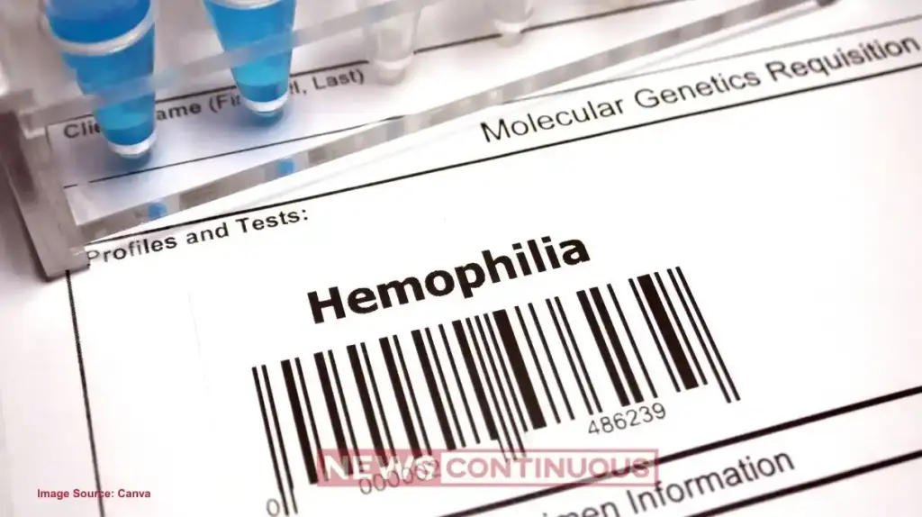 Hemophilia। ઈજા નથી થઈ છતાં કેમ પડે છે વાદળી ડાઘ? સાંધાના દુખાવા સાથે જોડાયેલું આ કનેક્શન જાણી તમે પણ ચોંકી જશો.