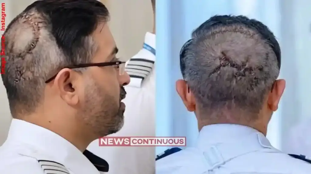 Captain Smit Machchhar Skull Fracture Details માથા પાછળ અસંખ્ય ટાંકા અને મોત સામે બે વાર ટક્કર! ૧૭૪ મુસાફરોનો જીવ બચાવનાર ગુજરાતી કેપ્ટનની અવિશ્વસનીય કહાણી