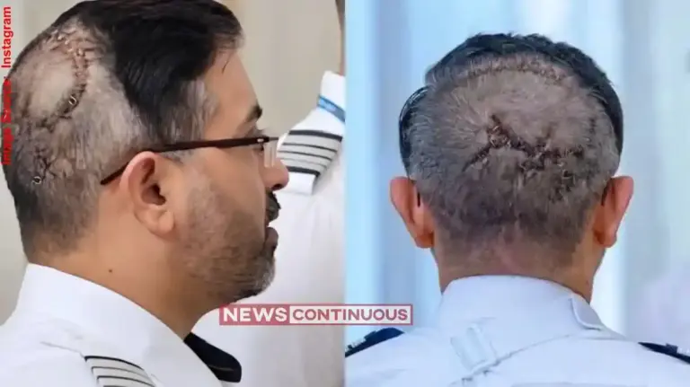 Captain Smit Machchhar Skull Fracture Details   માથા પાછળ અસંખ્ય ટાંકા અને મોત સામે બે વાર ટક્કર! ૧૭૪ મુસાફરોનો જીવ બચાવનાર ગુજરાતી કેપ્ટનની અવિશ્વસનીય કહાણી