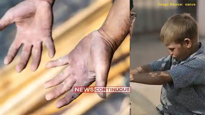 Malad Child Labour Rescue મલાડમાં ઈમિટેશન જ્વેલરી યુનિટમાંથી ૧૭ સગીર બાળમજૂરો મુક્ત ૧૦ બાય ૧૨ની ઓરડીમાં ૧૫૧૬ કલાક અમાનવીય મજૂરી, સંચાલક ઝડપાયો
